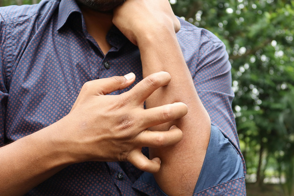 El dengue suele presentarse como un cuadro con fiebre alta, dolor muscular y articular intenso, o dolor de cabeza y detrás de los ojos.